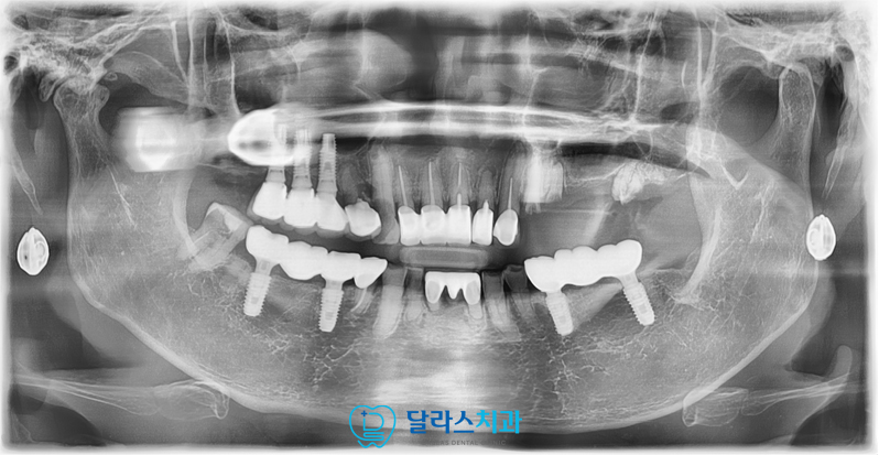 노원임플란트추천