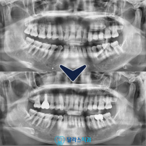 노원역임플란트