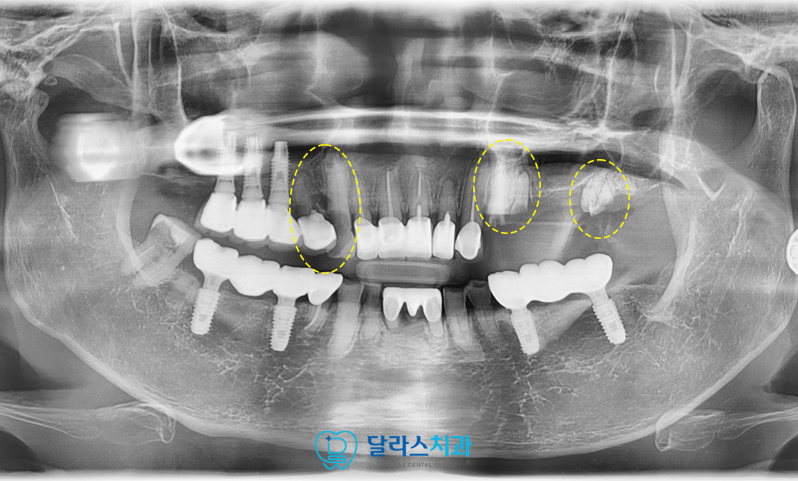 노원임플란트추천