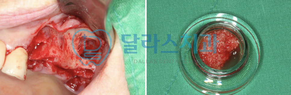 노원임플란트추천