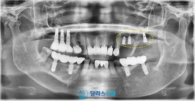 노원임플란트추천