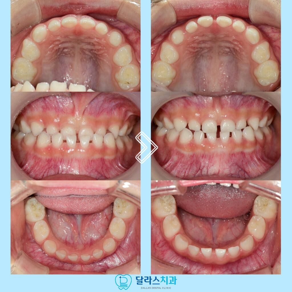 치료전과 치료이후의 모습