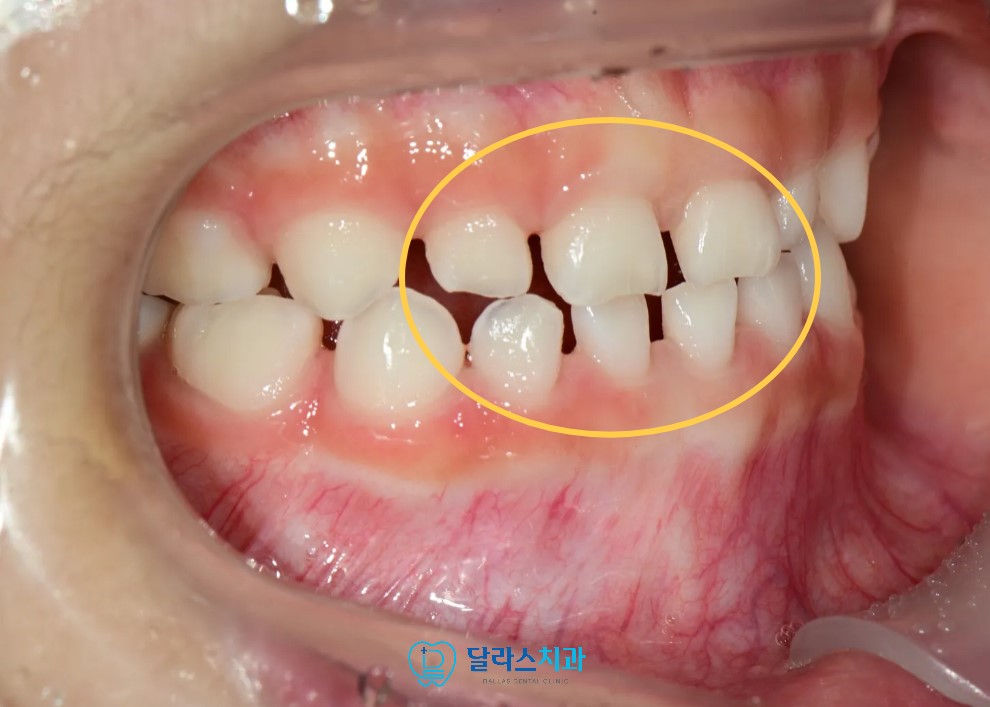 치료 이후 측면에서 본 모습