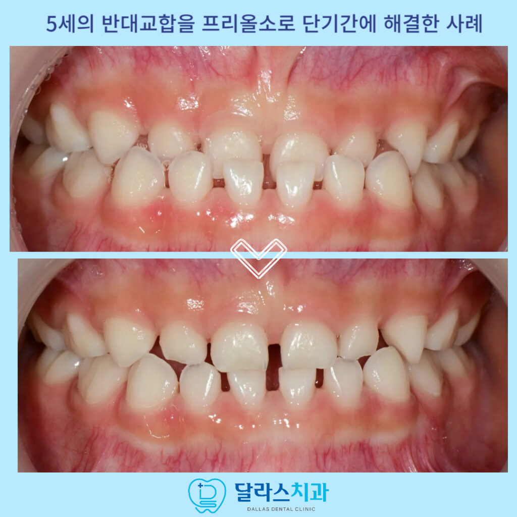 치료 전후 비교