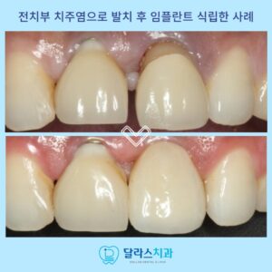 노원역임플란트