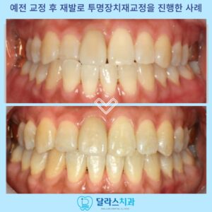 노원치아교정