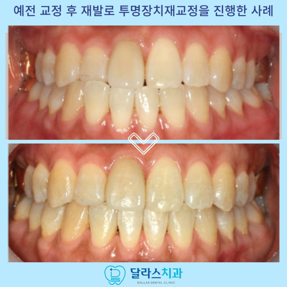 노원치아교정
