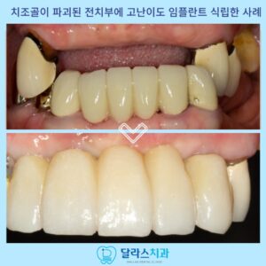노원임플란트