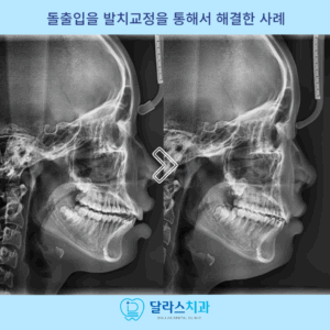 노원치아교정