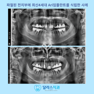 노원역임플란트