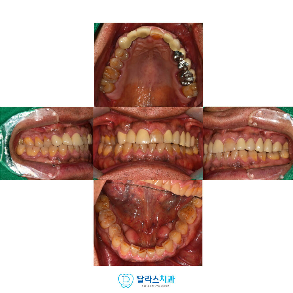 노원임플란트