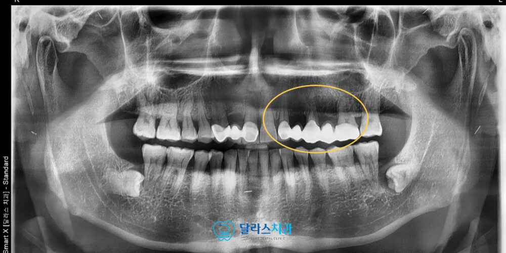 노원임플란트