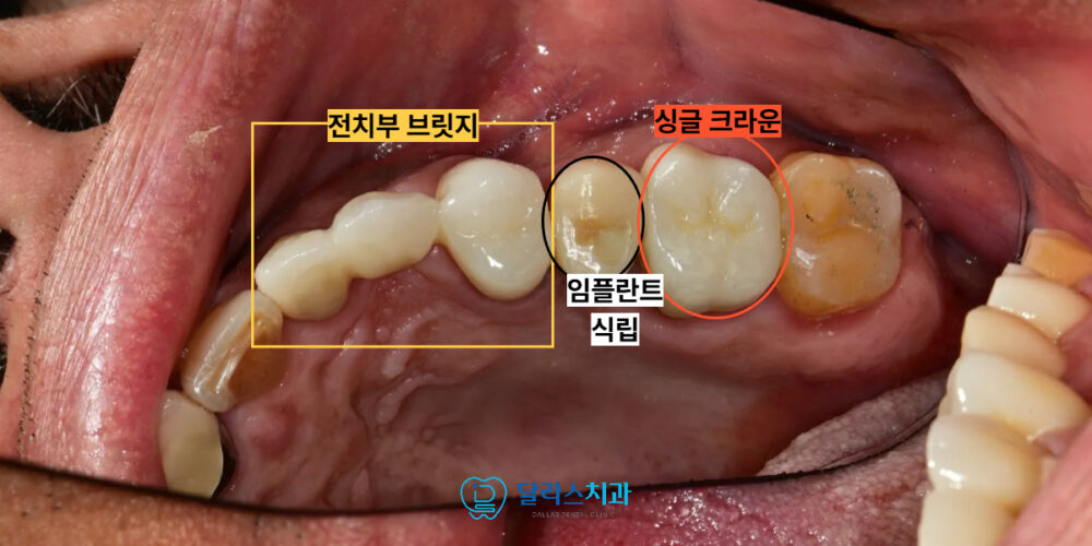 노원임플란트