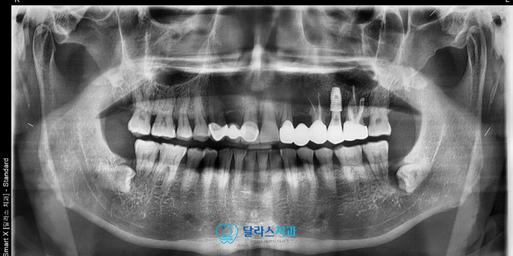 노원임플란트