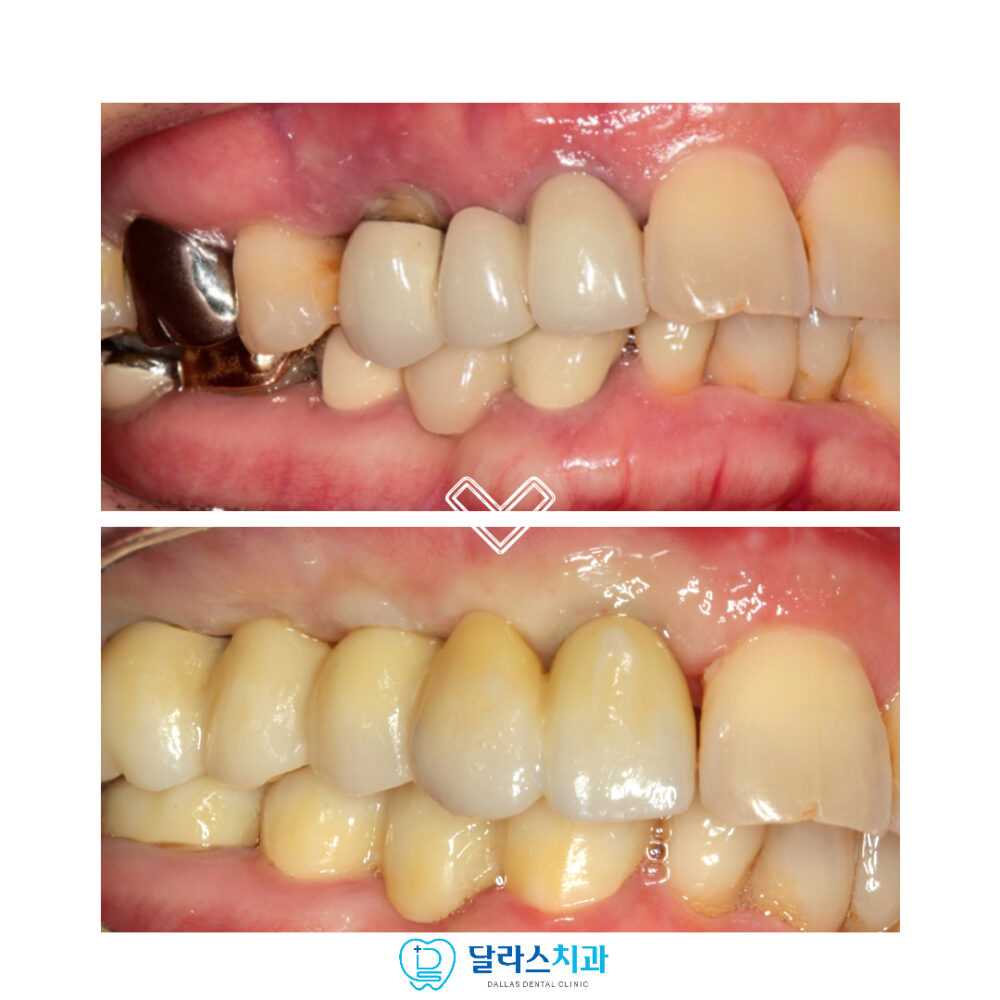 노원역임플란트