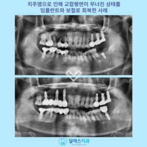 노원역임플란트