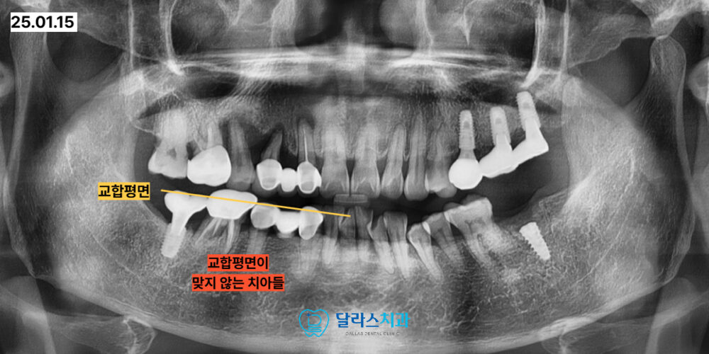 노원역임플란트