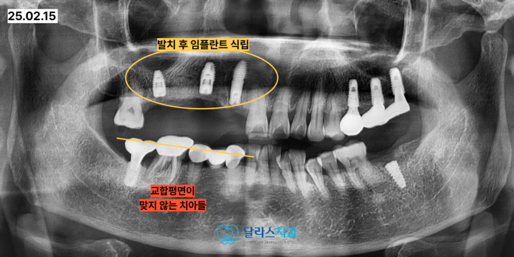 노원역임플란트
