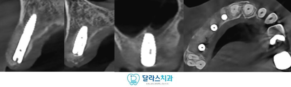 노원역임플란트