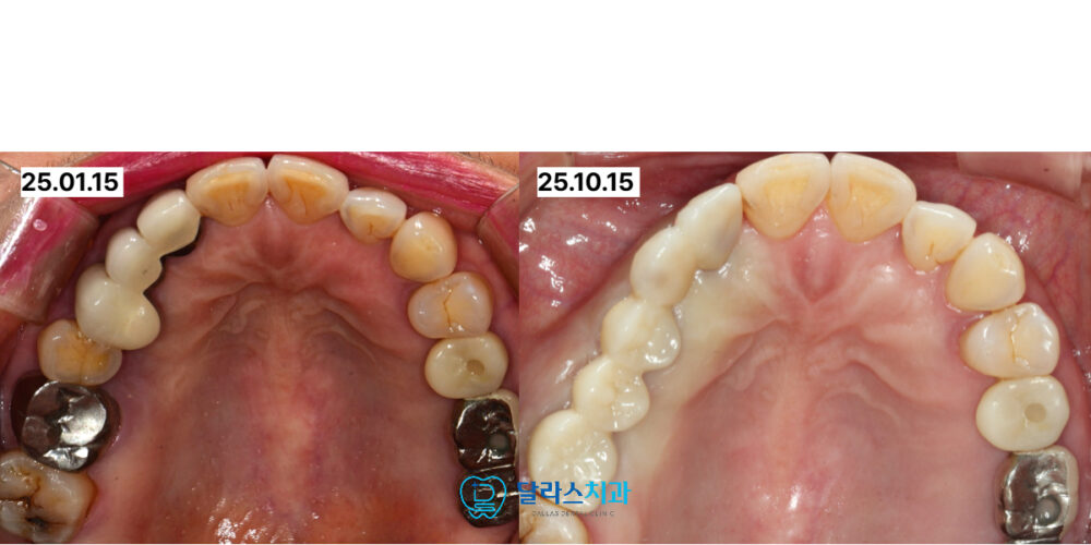 노원역임플란트